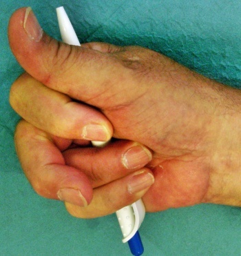 Drehfehler_Mittelfinger Drehfehler am Mittelfinger