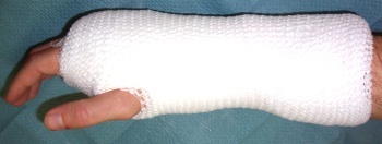 Unterarm_Gips