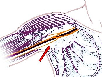chematische Darstellung des Plexus-brachialis
