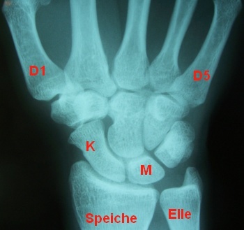 Handgelenk Röntgenbild