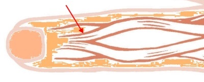 Grafik einer Strecksehne an der Hand